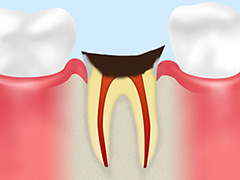 C4（歯根に達した虫歯）