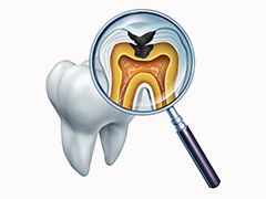 重度の虫歯は根管治療を