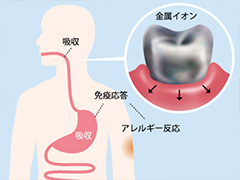 審美歯科は、体にも優しい治療です