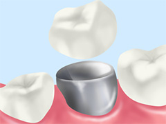 オールセラミック（インレー・クラウン）
